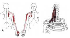 Upper Back, Shoulder, and Arm  The Trigger Point & Referred Pain